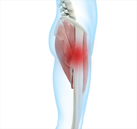 Greater Trochanteric Pain Syndrome Greater Trochanteric Pain Syndrome