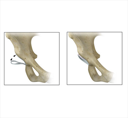 Acetabular Rim Trim