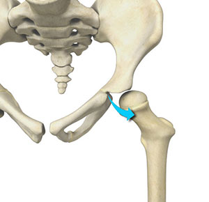 Borderline Dysplasia Image Borderline Dysplasia