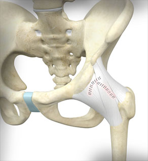 Capsular Closure