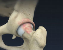 Femoral Osteoplasty