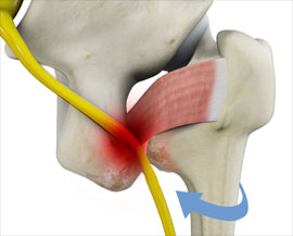 Ischiofemoral Impingement Ischiofemoral Impingement