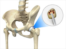 Hip Microfracture Hip Microfracture