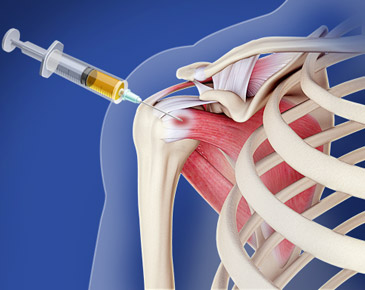 Stem Cell Therapy Stem Cell Therapy