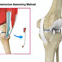 ACL Reconstruction Procedure - Hamstring Tendon 