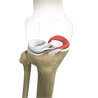 Medial Meniscus Syndrome