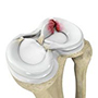 Meniscal Tears