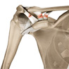 Acromioclavicular Joint (AC Joint) Dislocation